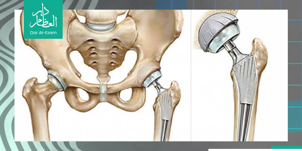 تغيير مفصل الحوض عملية تغيير مفصل الحوض ما بعد عملية تغيير مفصل الحوض